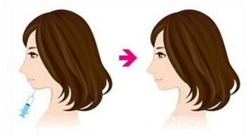 玻尿酸豐下巴前后效果對比