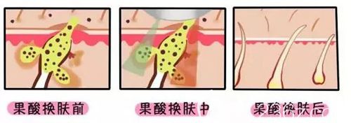果酸煥膚的祛痘原理步驟示意圖