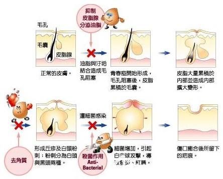 油痘肌形成痘痘的具體原因