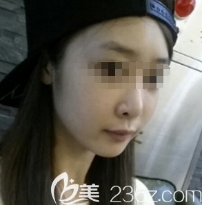 在邯鄲京美做膨體隆鼻術(shù)前是塌鼻子 在邯鄲京美做膨體隆鼻術(shù)前是塌鼻子