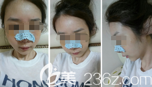 張偉醫(yī)生為我剛做完立秀膨體隆鼻術(shù)后鼻子微腫 張偉醫(yī)生為我剛做完立秀膨體隆鼻術(shù)后鼻子微腫