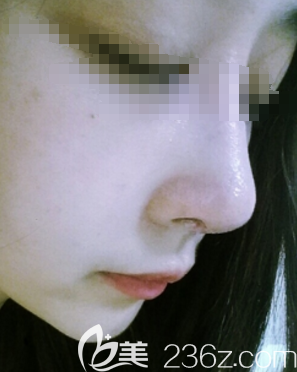 在邯鄲京美做膨體隆鼻術(shù)后一周鼻子拆線 在邯鄲京美做膨體隆鼻術(shù)后一周鼻子拆線