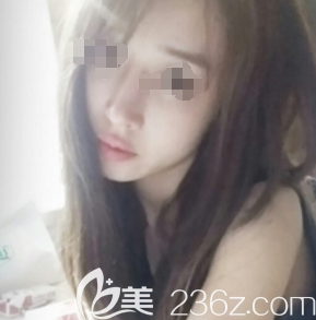 張偉醫(yī)生為我做膨體隆鼻術(shù)后20天鼻子消腫 張偉醫(yī)生為我做膨體隆鼻術(shù)后20天鼻子消腫