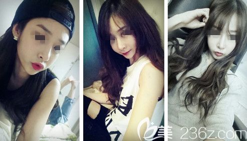 怕膨體隆鼻后遺癥的姐妹可以來(lái)看看我找張偉醫(yī)生用立秀膨體做的隆鼻效果