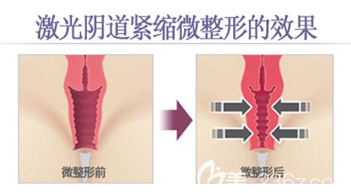 韓國如妍激光陰道手術(shù)