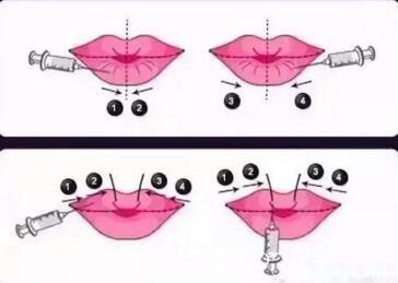 玻尿酸豐唇過程示意圖