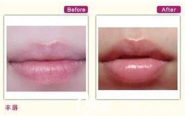 玻尿酸豐唇前后對比照