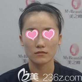在美之峰做面部脂肪填充術(shù)前照 在美之峰做面部脂肪填充術(shù)前照