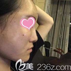 做自體脂肪填充面部術(shù)后3天 做自體脂肪填充面部術(shù)后3天