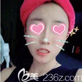 在美之峰做面部脂肪填充術(shù)后18天效果圖 在美之峰做面部脂肪填充術(shù)后18天效果圖