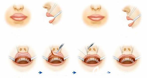 厚唇改薄手術(shù)過程示意圖