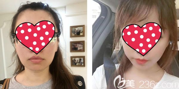 厚唇改薄兩年后真實(shí)照片