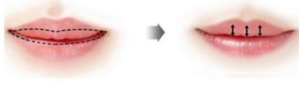 厚唇改薄一年后又厚了真相揭秘