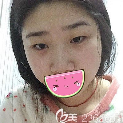 在南陽維多利亞做眼鼻手術(shù)前的丑樣 在南陽維多利亞做眼鼻手術(shù)前的丑樣