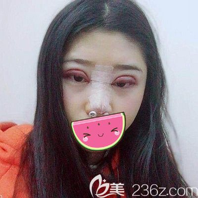 在南陽維多利亞做雙眼皮和隆鼻3天后的改變 在南陽維多利亞做雙眼皮和隆鼻3天后的改變