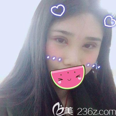 做全切雙眼皮和硅膠假體隆鼻后7天的樣子 做全切雙眼皮和硅膠假體隆鼻后7天的樣子