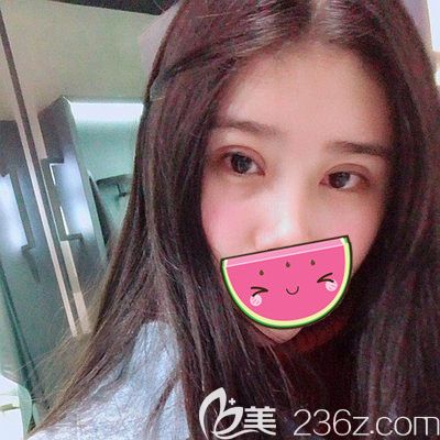 做全切雙眼皮和硅膠假體隆鼻1個(gè)月后的改變是我這趟南陽之旅的超值收獲