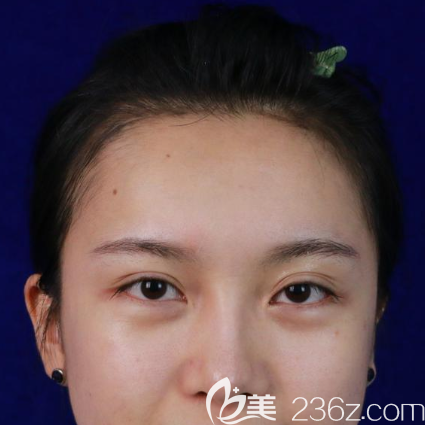 廣州韓妃醫(yī)學(xué)整形美容門診部李光琴術(shù)前照片1