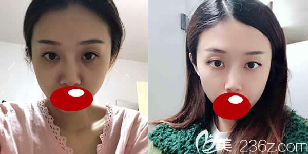 福州名韓溫名赟醫(yī)生自體脂肪全面部填充前后對(duì)比效果