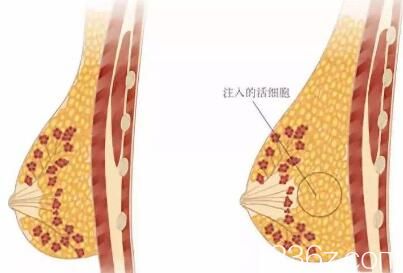 自體脂肪豐胸的方法是注入活性細(xì)胞