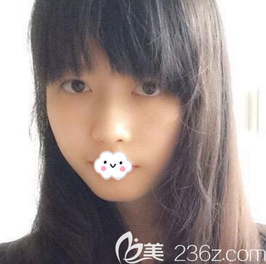 在廣州廣大整形做隆鼻術(shù)前照片 在廣州廣大整形做隆鼻術(shù)前照片