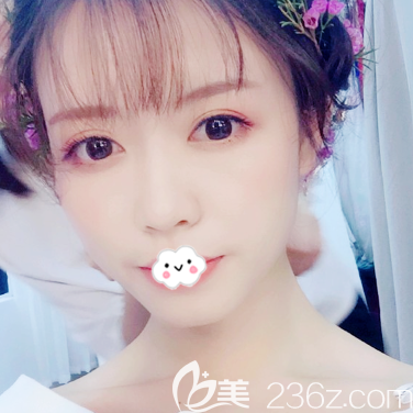 廣州廣大整形醫(yī)院王政醫(yī)生做的隆鼻<span style= 廣州廣大整形醫(yī)院王政醫(yī)生做的隆鼻<span style=