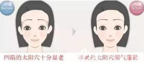 自體脂肪豐太陽穴會有哪些后遺癥 自體脂肪豐太陽穴會有哪些后遺癥