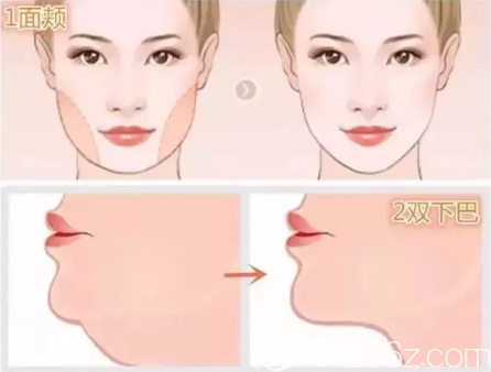 雙下巴吸脂的風(fēng)險是什么