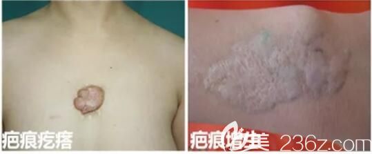 增生性疤痕和疤痕疙瘩的區(qū)別