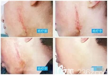 增生性疤痕治療案例