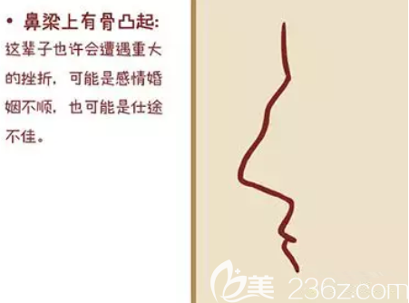 駝峰鼻長什么樣