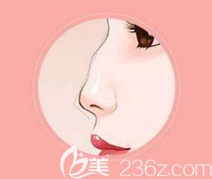 做駝峰鼻矯正手術(shù)不知道有沒(méi)有風(fēng)險(xiǎn)？