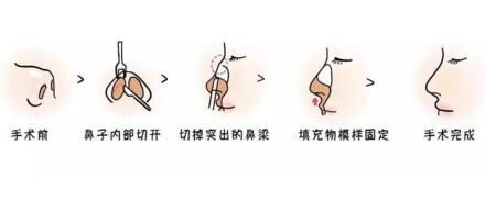 做駝峰鼻矯正手術(shù)過(guò)程示意圖