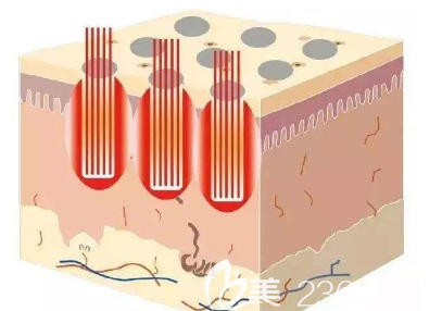 點陣激光的示意圖