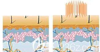 點陣激光祛痘的樣子
