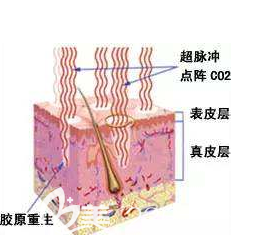 點陣激光對皮膚的刺激