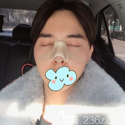 洛陽愛尚耳軟骨隆鼻術(shù)后3天