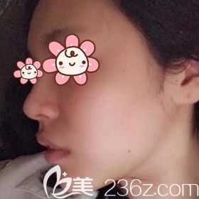 在沈陽名流做假體墊下巴術(shù)后5天效果圖