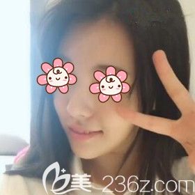 在沈陽做假體墊下巴術(shù)后半個月效果