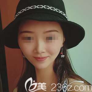 <!--<i data=20240703-sp></i>-->整形醫(yī)生陳珍為我做皮秒祛斑術(shù)后一周色斑祛除