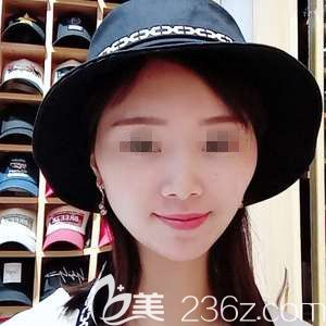 初次找陳珍醫(yī)生做皮秒激光祛斑術20天就讓我輕松擺脫22年的滿臉雀斑