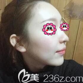 注射玻尿酸墊下巴術(shù)后4天照