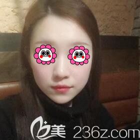 在長沙雅美打玻尿酸豐下巴術(shù)后21天效果