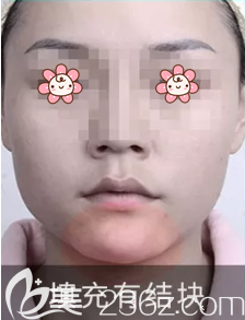 下巴有結(jié)塊