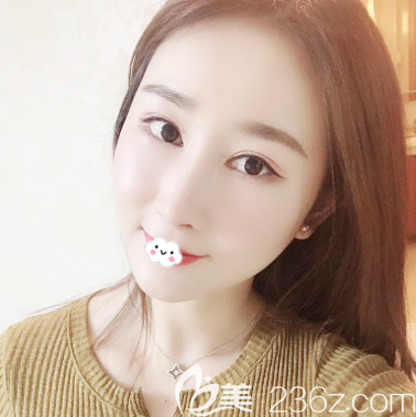 廣州曙光隆鼻案例一個月效果圖 廣州曙光隆鼻案例一個月效果圖