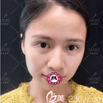 北京美萊上瞼提肌+祛皮祛脂+雙眼皮案例 北京美萊上瞼提肌+祛皮祛脂+雙眼皮案例