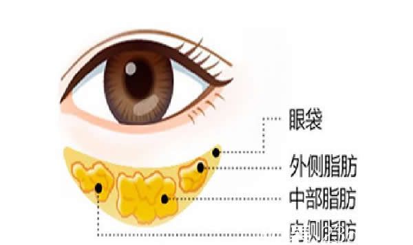 聚能美雕祛眼袋技術(shù)原理