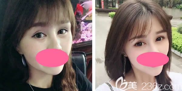 真人案例：29歲妹紙做聚能美雕祛眼袋術(shù)后一個(gè)月效果