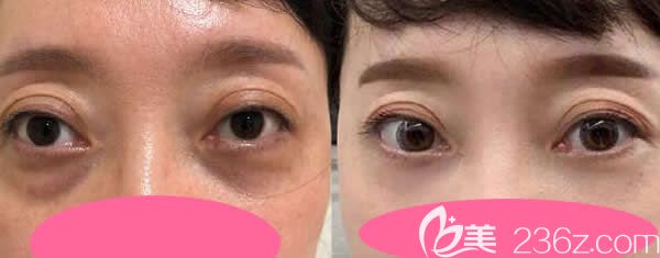 真人案例：40歲大姐做聚能美雕祛眼袋二十八天效果