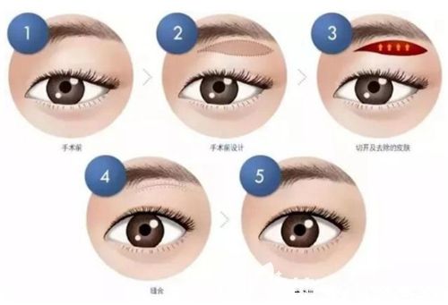 懸吊式提眉手術(shù)方法步驟圖